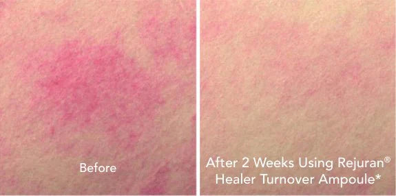 REJURAN Turnover Ampoule 0.5% cPDRN - RIMAN KBeauty - Korean Skincare Routine for Glass Skin